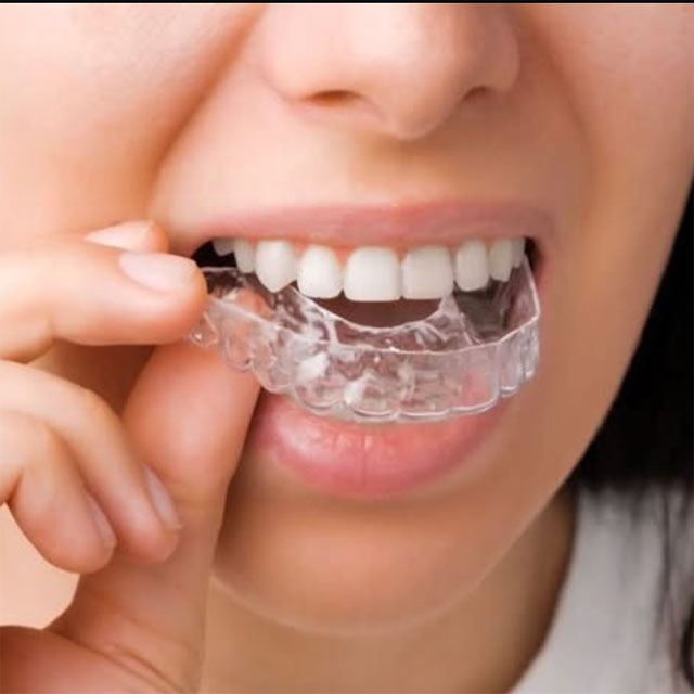 Invisible Orthodontics - Florida Dental Cosmetic